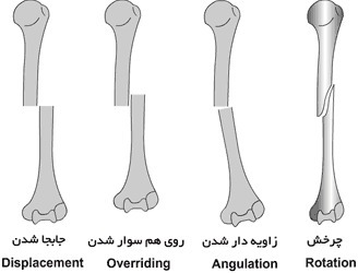 انواع شکستگی استخوان ها